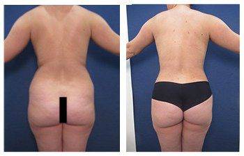 body contouring Los Angeles