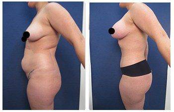 360 liposuction Dana Point