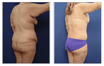 How Painful is Post Bariatric Body Lift