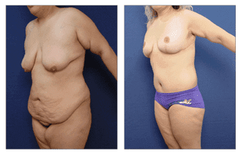 Post Bariatric Body Lift Los Angeles