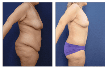 Breast Lift San Diego