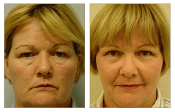 Fat Transfer for Female Faces