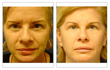 Fat Transfer for Female Faces