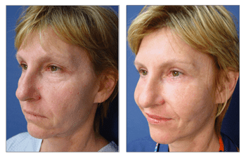 Blepharoplasty women patient