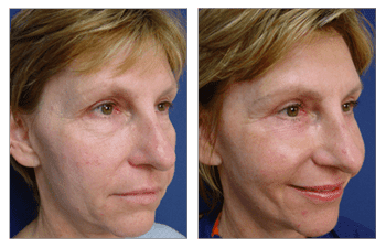 Fat Transfer and Lower Blepharoplasty