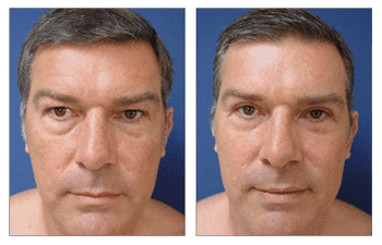 Fat Transfer for Male Faces