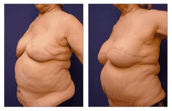 Fat Transfer Following Breast Reconstruction