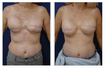 Fat Transfer Following Breast Radiation