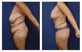 Plastic Surgery After Weight Loss