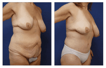 Post-Bariatric Body Lift Beverly Hills