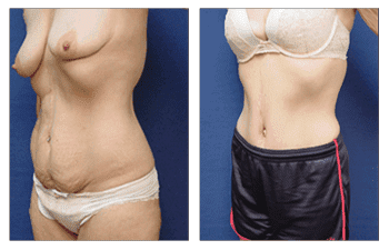 abdominoplasty San Diego