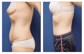 Post-Bariatric Body Lift Newport Beach