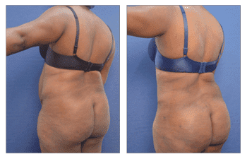 Skin reduction Surgery 