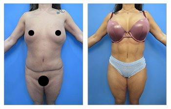 Abdomen Liposuction in Morgantown, WV or surrounding areas