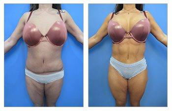 Case Study: Secondary Liposuction After Tummy Tuck Surgery