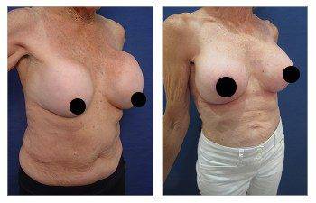 Before and after images for Fixing Capsular Contracture Deformities