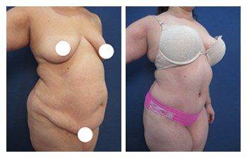 Staged body contouring result