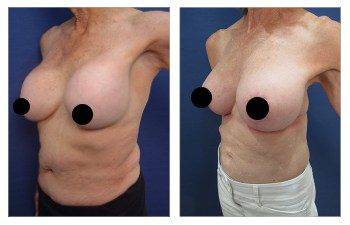 Before and after images for Fixing Capsular Contracture Deformities