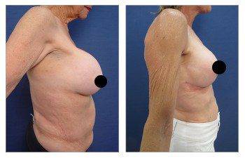 Before and after images for Fixing Capsular Contracture Deformities