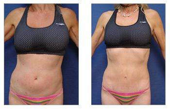 Tummy Tuck surgery or abdominoplasty in skilled hands is amazing