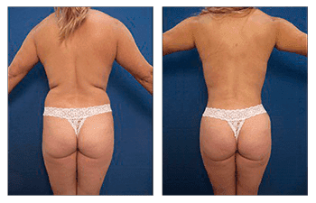 Before and after pictures of a woman's tummy tuck on a Newport Beach Liposuction Landing Page.