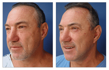 A man's face undergoes a transformation before and after a facelift procedure.