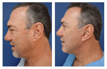 Facelift Preparation