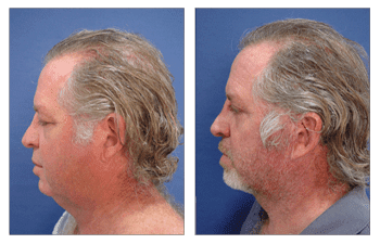 Facelift Age Recommendations - before and after image of a patient