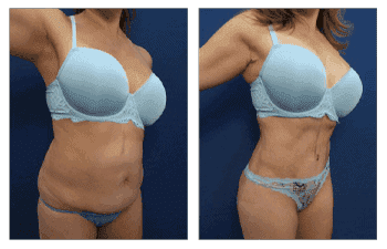 Is Muscle Repair with Tummy Tuck Always Necessary? - Power Plastic