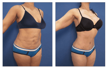 Check out the remarkable transformation of tummy tuck before and after in Newport Beach. Experience the benefits of liposuction on our dedicated landing page.