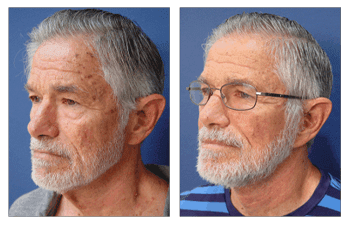 Can a facelift go wrong?