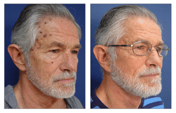 A man with a beard and glasses before and after undergoing a facelift.