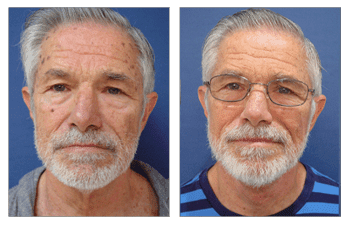 Can a facelift go wrong?