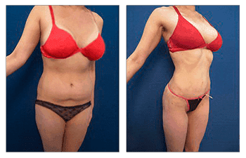 Newport Beach Liposuction Tummy Tuck Before and After Pictures.