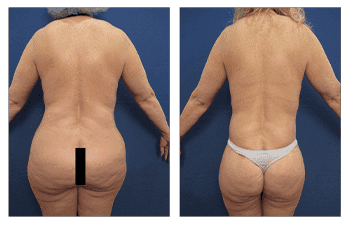 Tummy tuck before and after, BBL revision worth