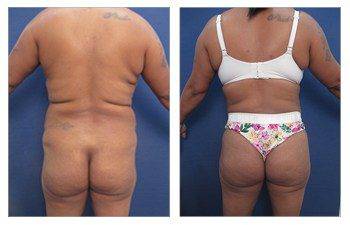 Tummy tuck for lateral hip dip before and after.