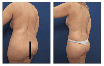 Lower body lift to eliminate buttock sagging and tighten her buttock