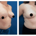 A woman's breast before and after surgery to fix breast Herniation.