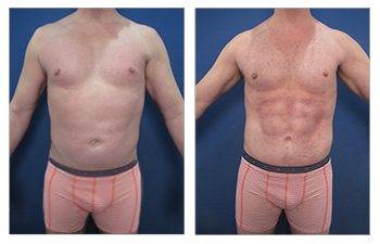 Newport Beach liposuction before and after tummy tuck.