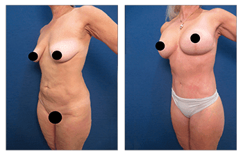 Mommy Makeover To Improve Belly Button Position