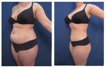 Cabbabe Plastic Surgery - Plus size tummy tuck (BMI 36) 3 months post op.  .. Plus size patients have a BMI>30. These patients have protuberant  abdomens as a result of visceral fat