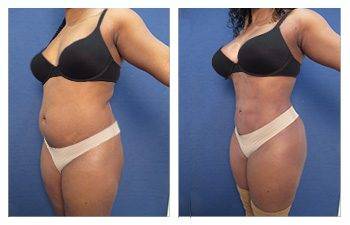 View the incredible before and after transformations of tummy tuck procedures on our Newport Beach liposuction landing page.