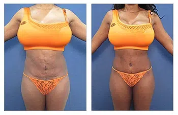 44-year-old female high definition liposuction revision procedure