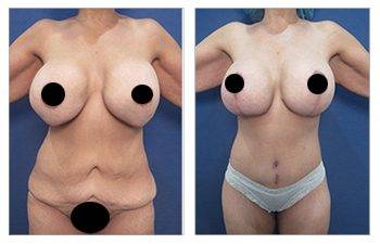 Mommy Makeover With Tummy Tuck And Breast Lift