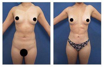 Combining tummy tuck with Lipo 360
