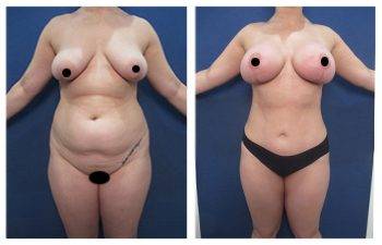 Does tummy tuck remove stretch marks