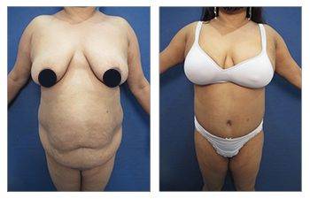 HD Lipo 360 Body Contouring