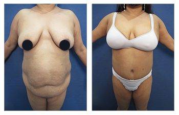 Cabbabe Plastic Surgery - Plus size tummy tuck (BMI 36) 3 months post op.  .. Plus size patients have a BMI>30. These patients have protuberant  abdomens as a result of visceral fat