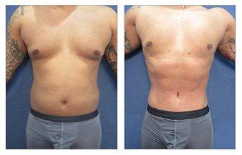 High Definition Body Contouring for the Plus-size Patient