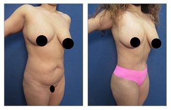 high definition body contouring